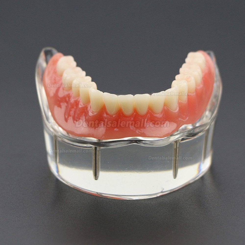 Dental Lower Teeth Demo Study Model 6002 02 Overdenture Inferior 4 Implants